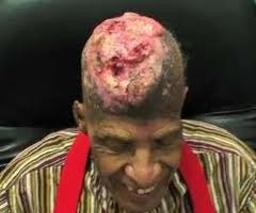 Radiation Experiment left hole in man's head